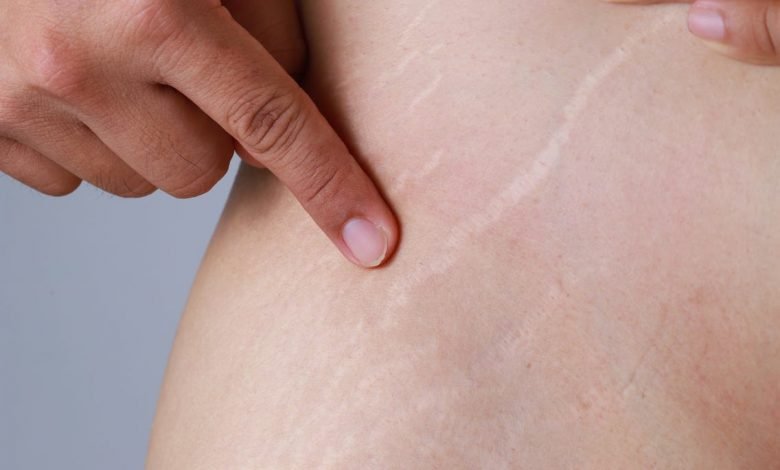 Fastest Way to Get Rid of Stretch Marks