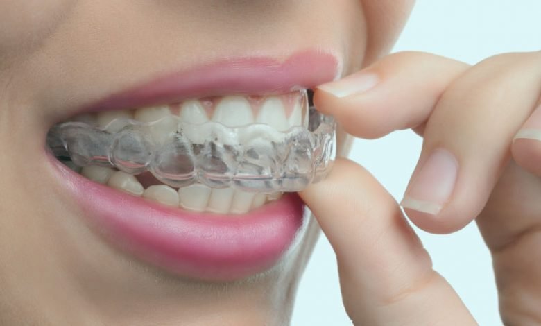 How much are clear correct braces?