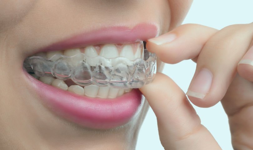 How much are clear correct braces?