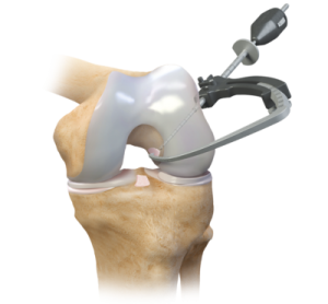 Knee Arthroscopy Implants 