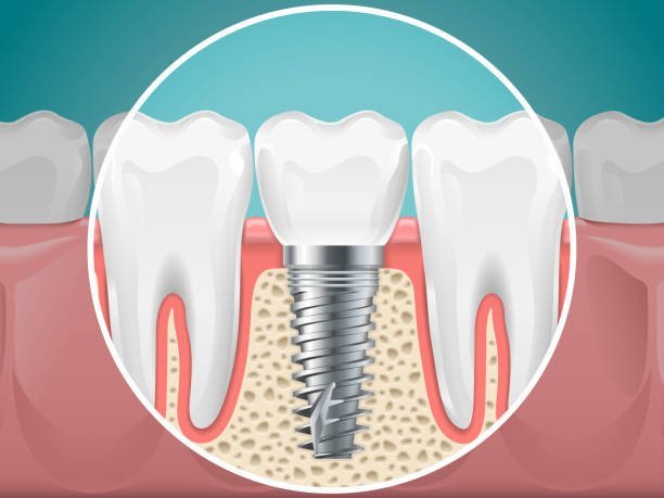 Pros and Cons of Dental Implants