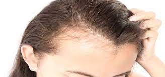body hair loss- Possible Causes and Treatment of Hair Loss in Teenagers