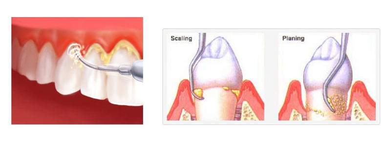 Tooth Scaling and Root Planing