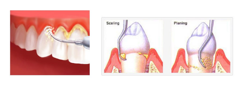 Tooth Scaling and Root Planing