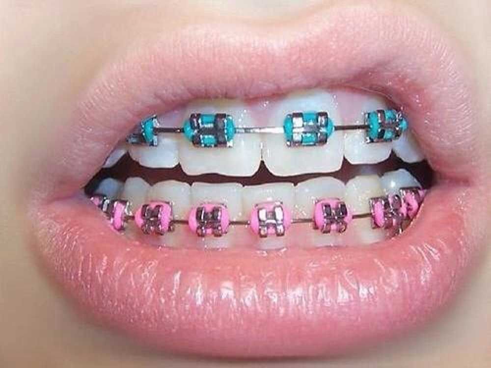 Best Braces
