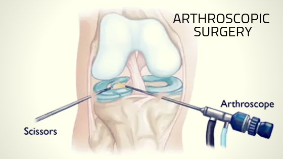 arthroscopy surgery