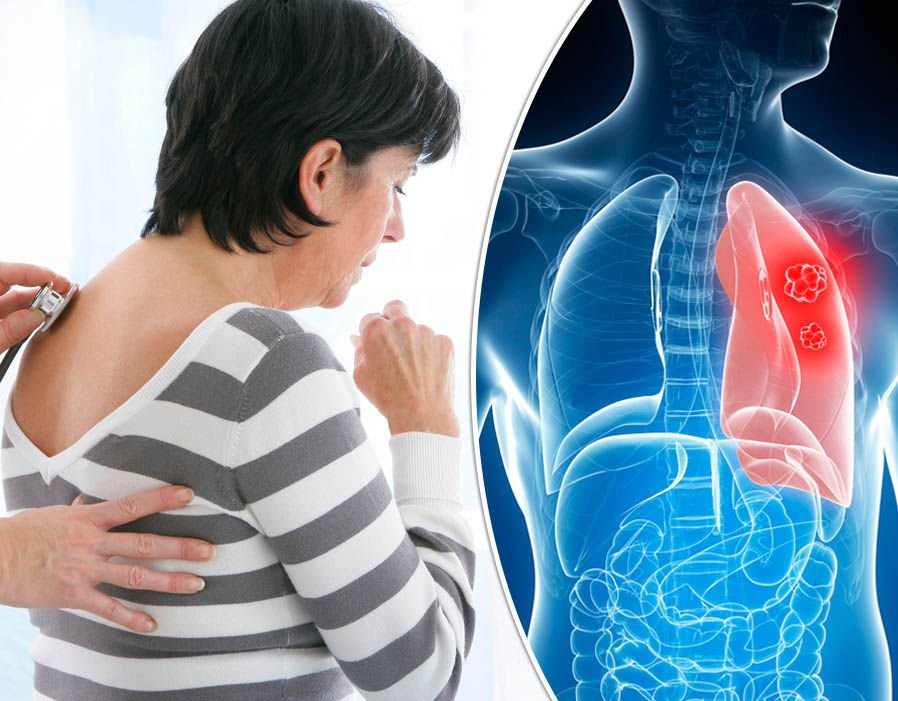 Immunotherapy for lung cancer