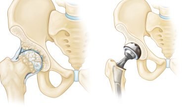 When Should You Consider Joint Replacement?