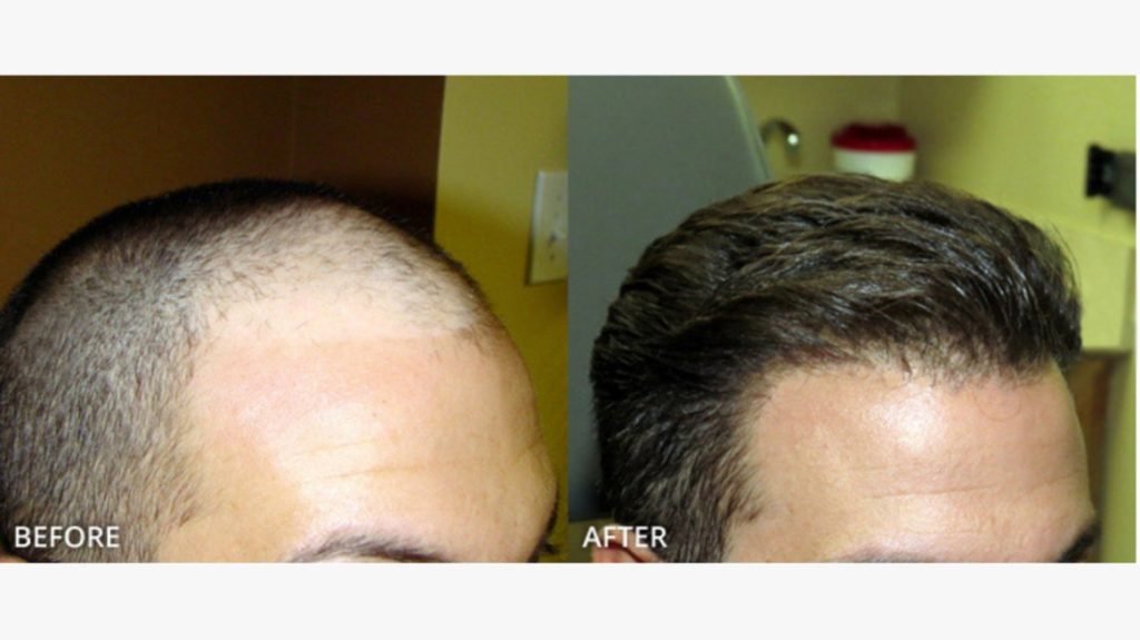 Hair transplant