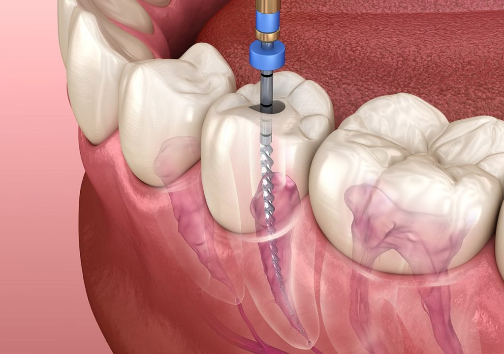 Root Canal