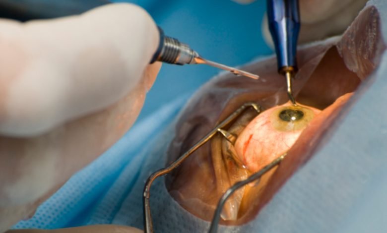 Cataract Surgery