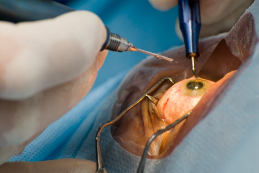 Cataract Surgery