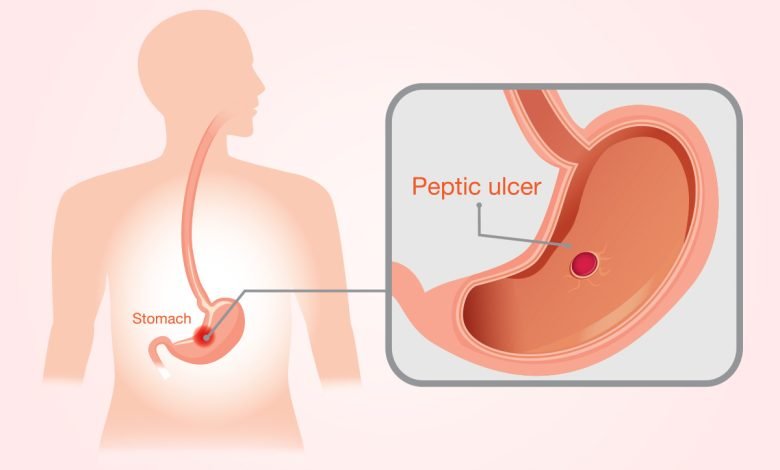 Is Stomach Ulcer Dangerous